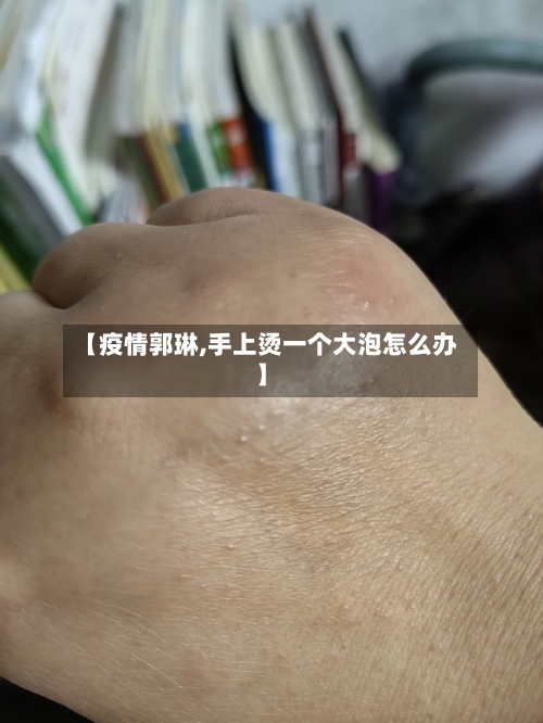 【疫情郭琳,手上烫一个大泡怎么办】